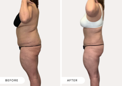 Before and After female abdomen and hips, lopve handles body sculpting results