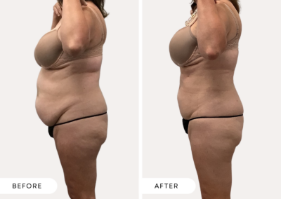 Before and After plus size female abdomen body sculpting results