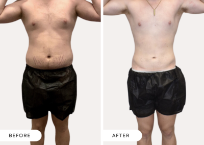 Before and after image of a male abdomen