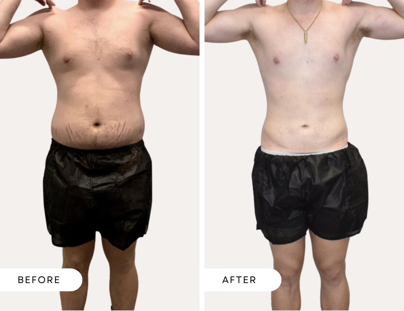 Before and after image of a male abdomen