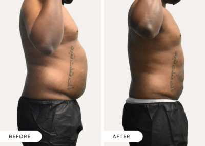 Before and after image of a black male abdomen