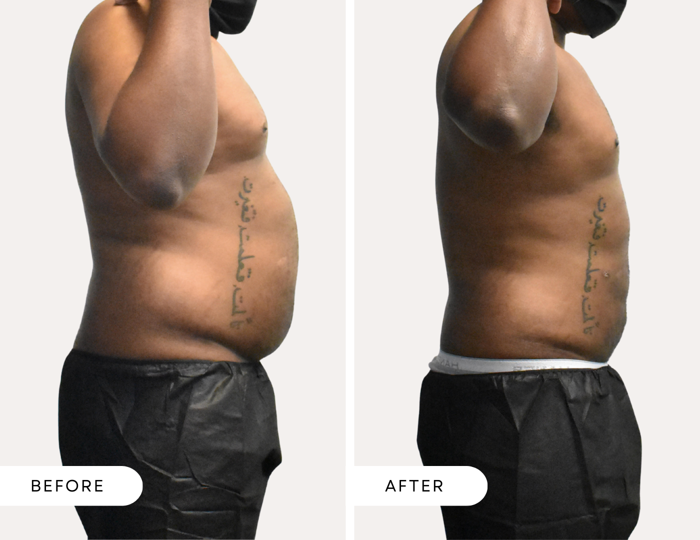 Before and after image of a black male abdomen