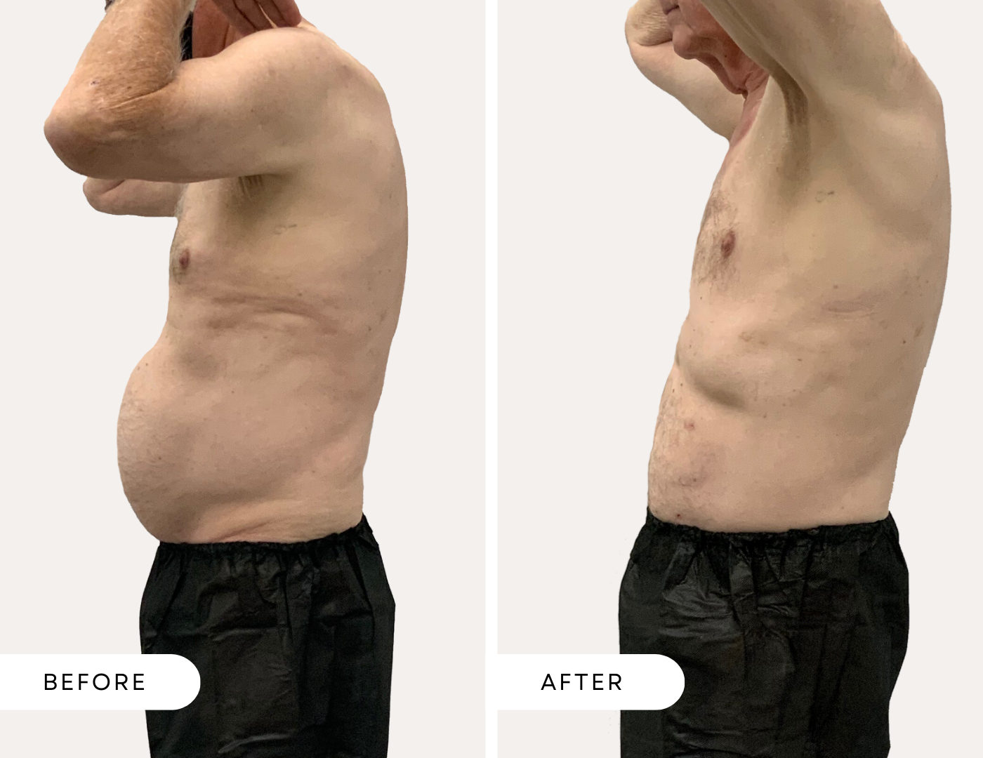 Before and after image of an older male abdomen