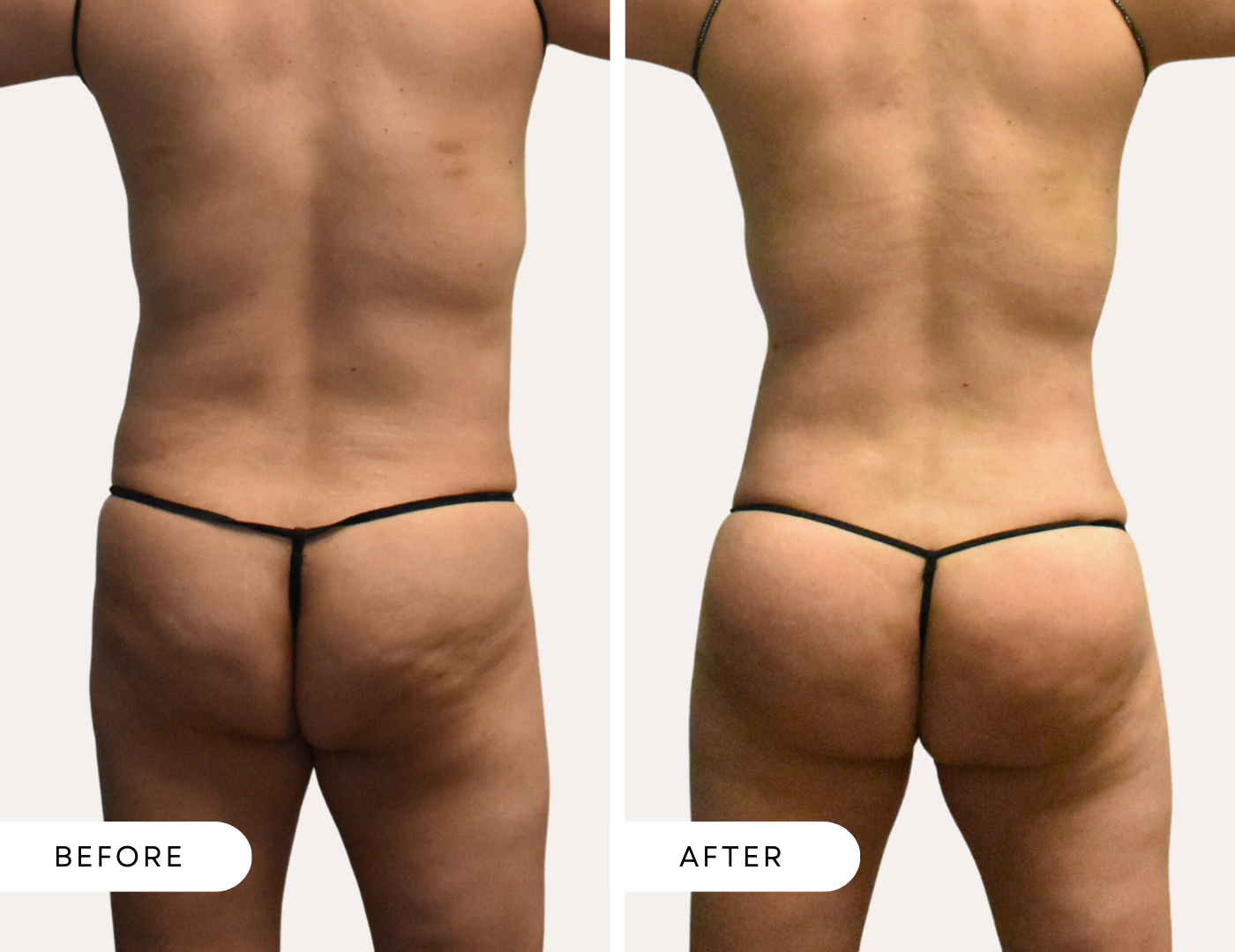 Female before and after photo. Fat Transfer results. Buttocks and Back.