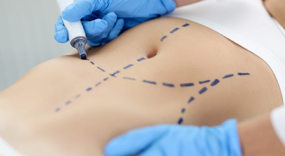 How BelleSculpt delivers results without surgery