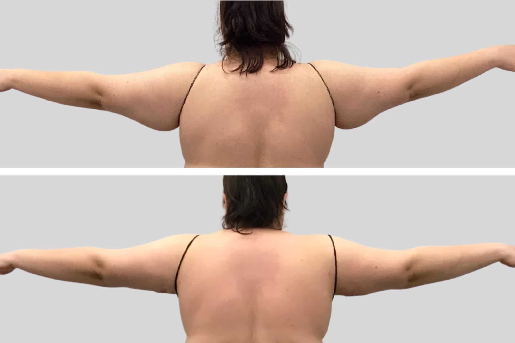 Before and After Image: Arm Sculpting - back