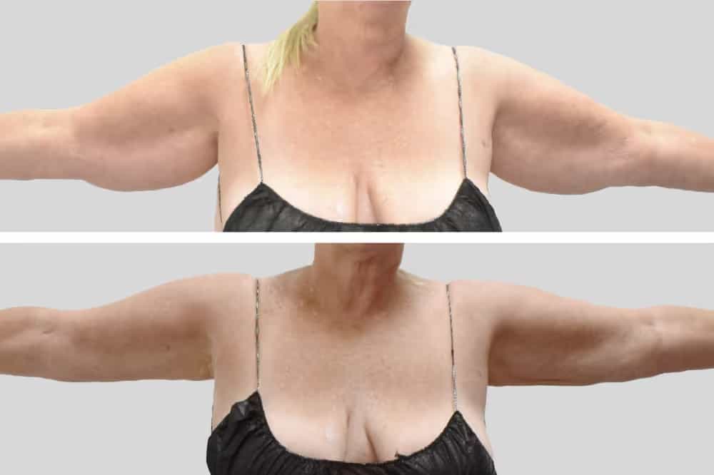 Before and After Image: Arm Sculpting - front