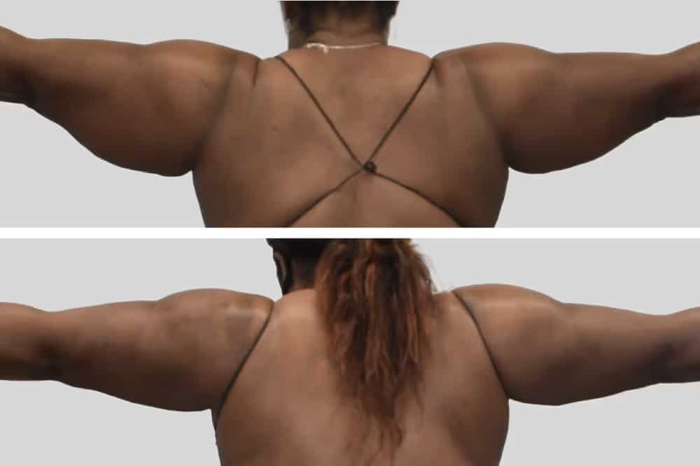 Before and After Image: Arm Sculpting - back