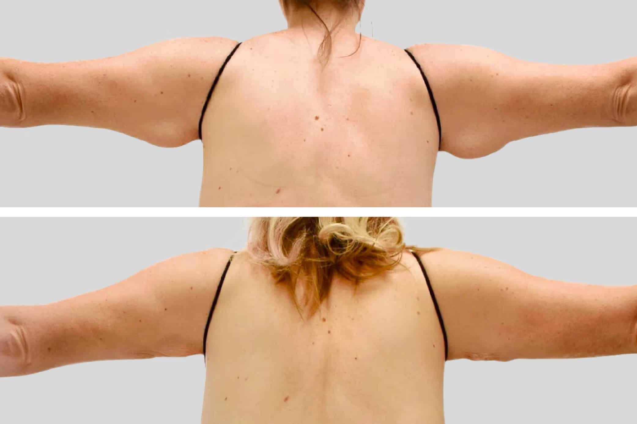 Before and After Image: Arm Sculpting - back