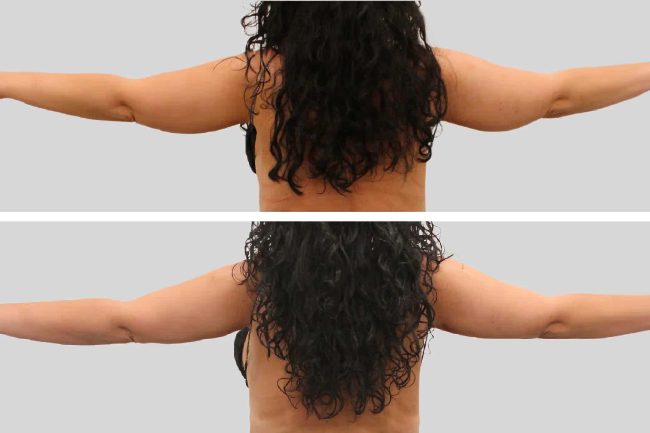 Before and After Image: Arm Sculpting - back
