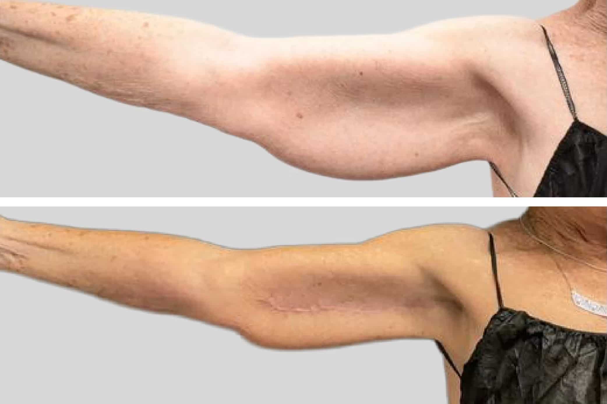 Before and After Image: Brachioplasty - front