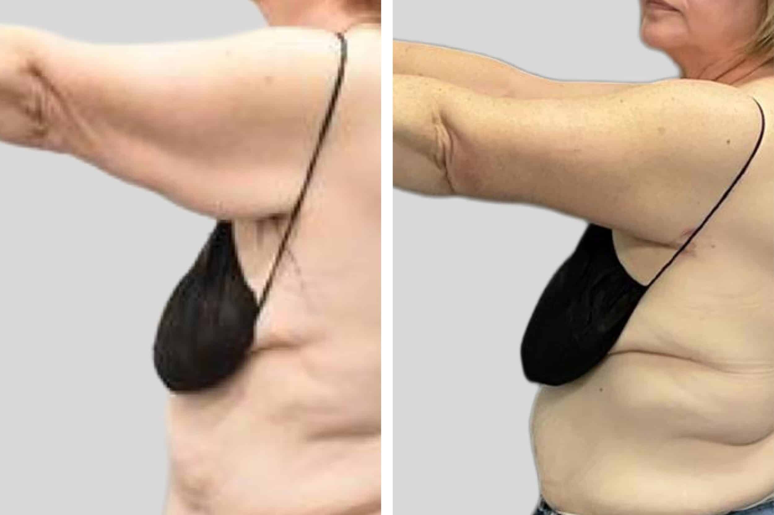 Before and After Image: Brachioplasty - left-side