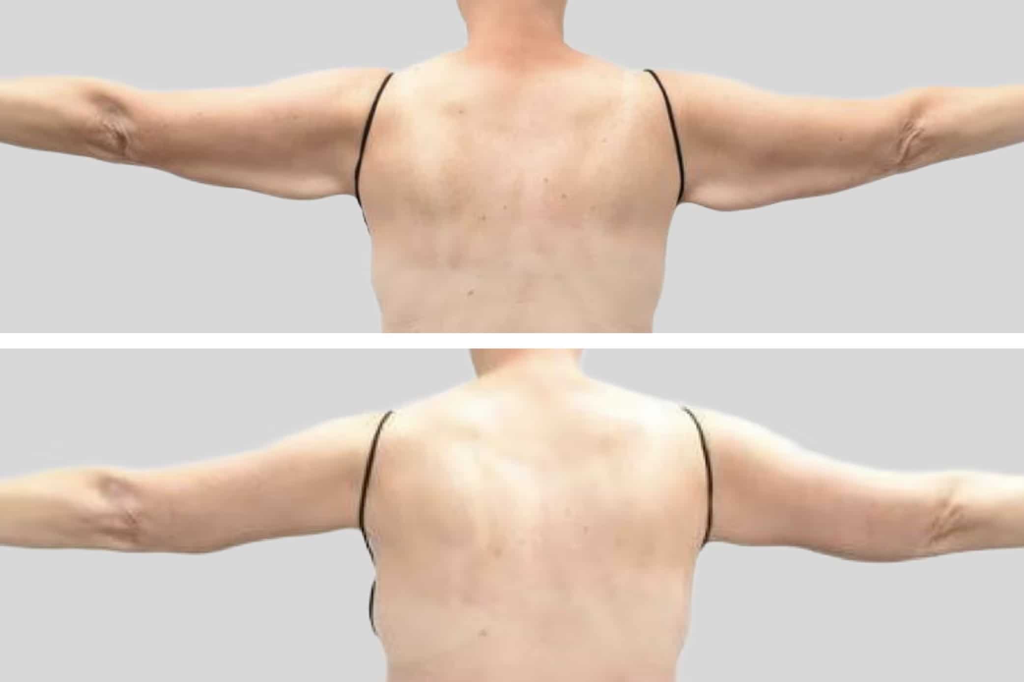 Before and After Image: Brachioplasty - back