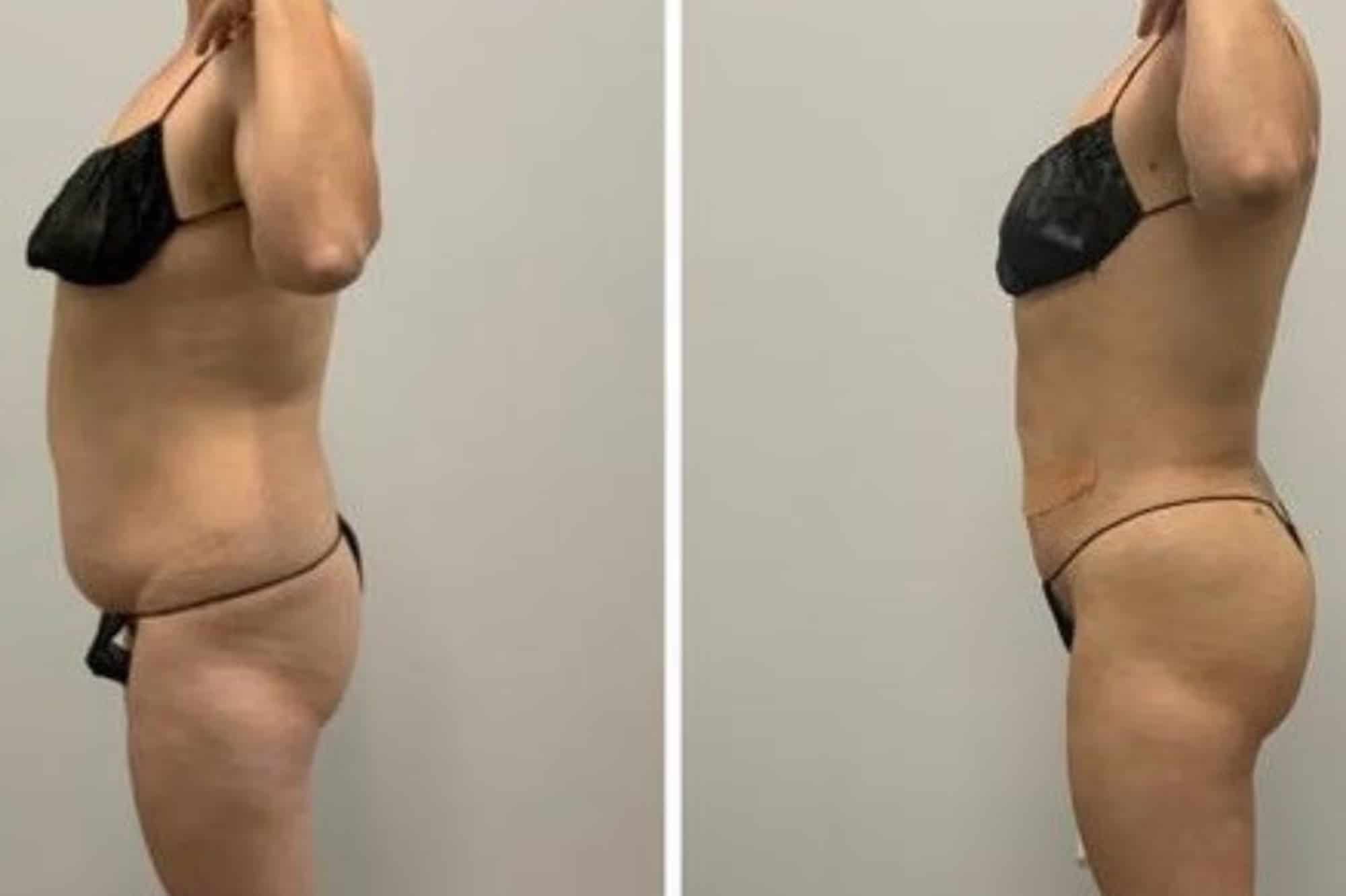 Before and After Image: BelleSculpt 360 - left-side