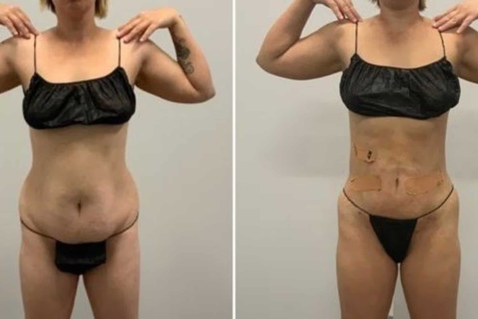 Before and After Image: BelleSculpt 360 - front