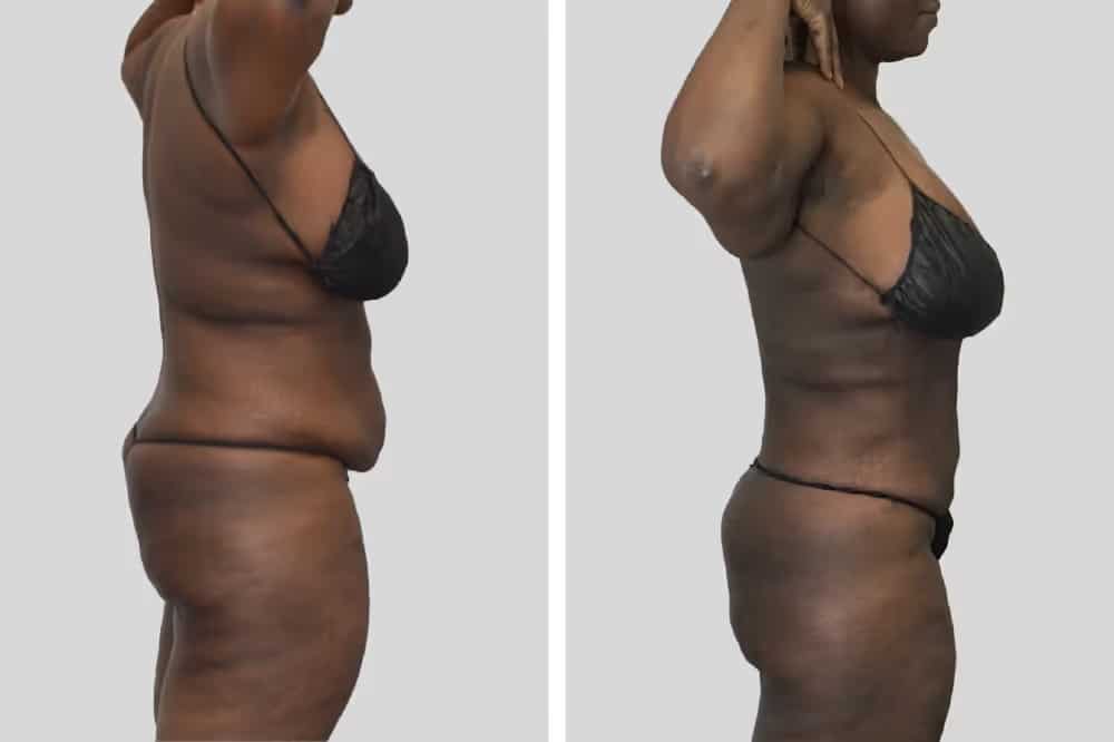 Before and After Image: BelleSculpt 360 - right-side