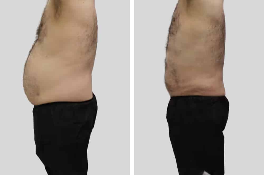 Before and After Image: BelleSculpt 360 - left-side