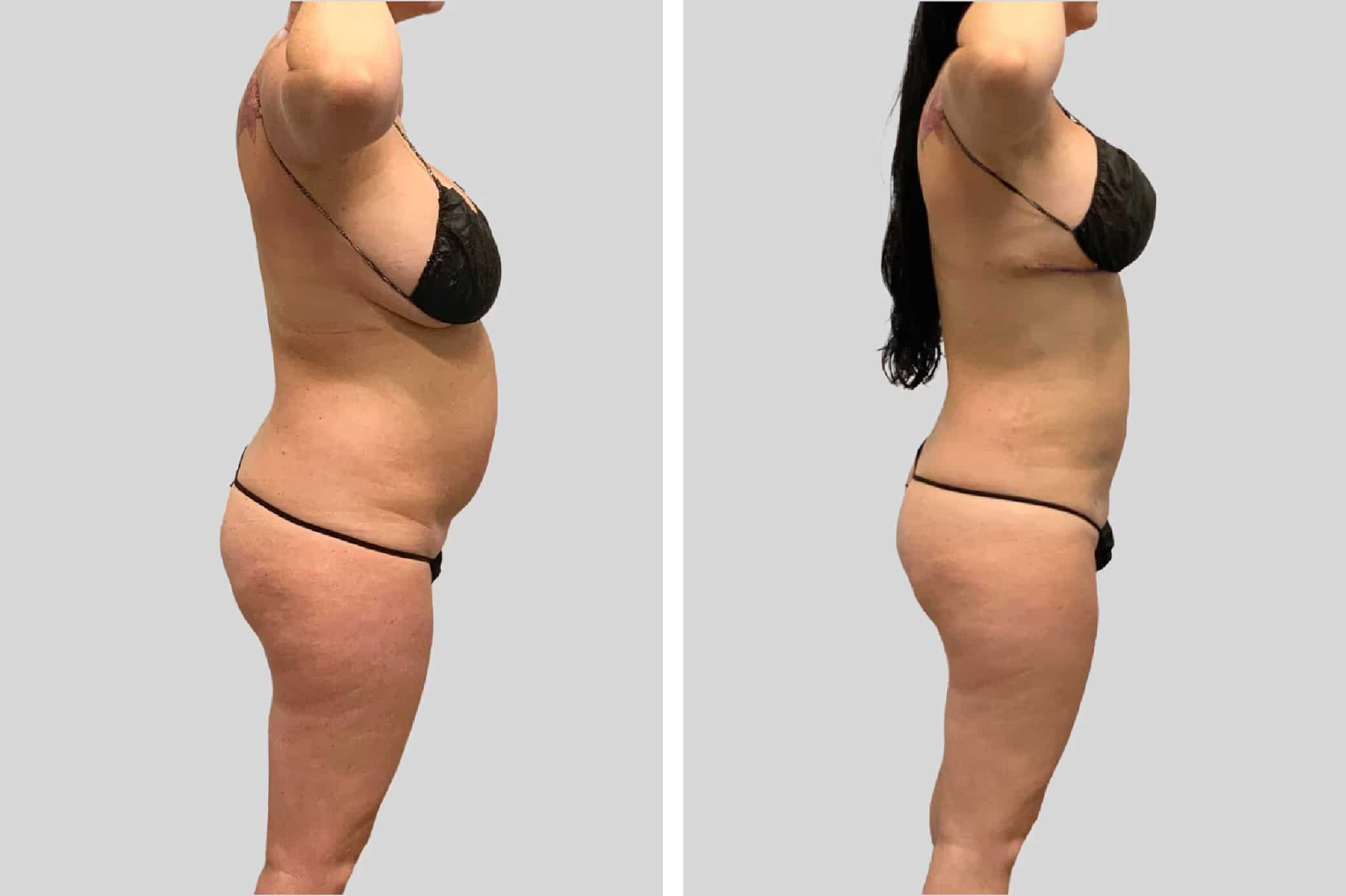 Before and After Image: BelleSculpt 360 - right-side