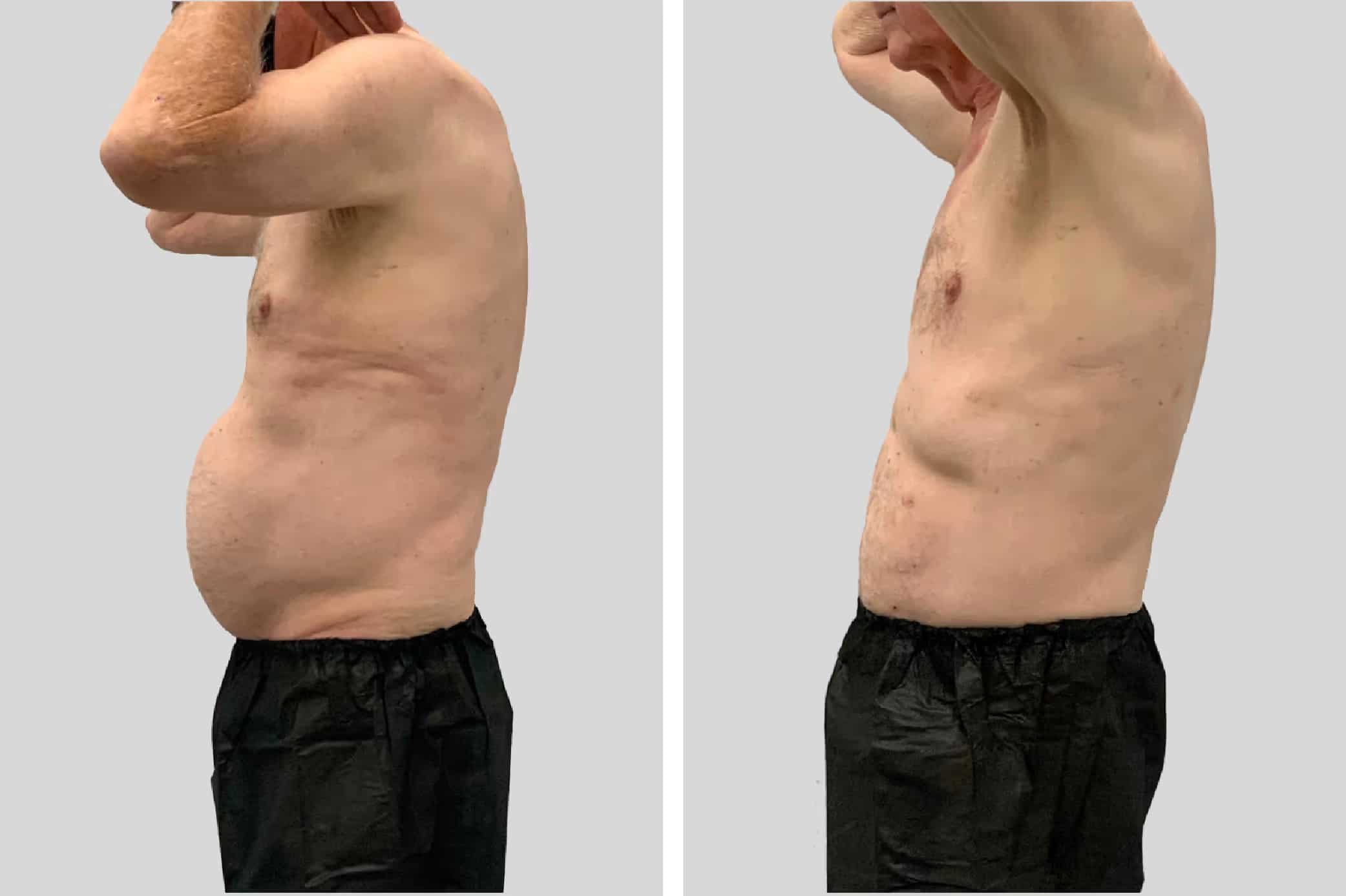 Before and After Image: BelleSculpt 360 - left-side