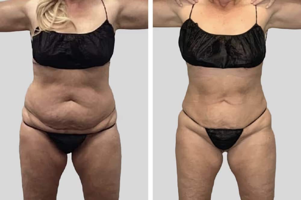 Before and After Image: BelleSculpt 360 - front