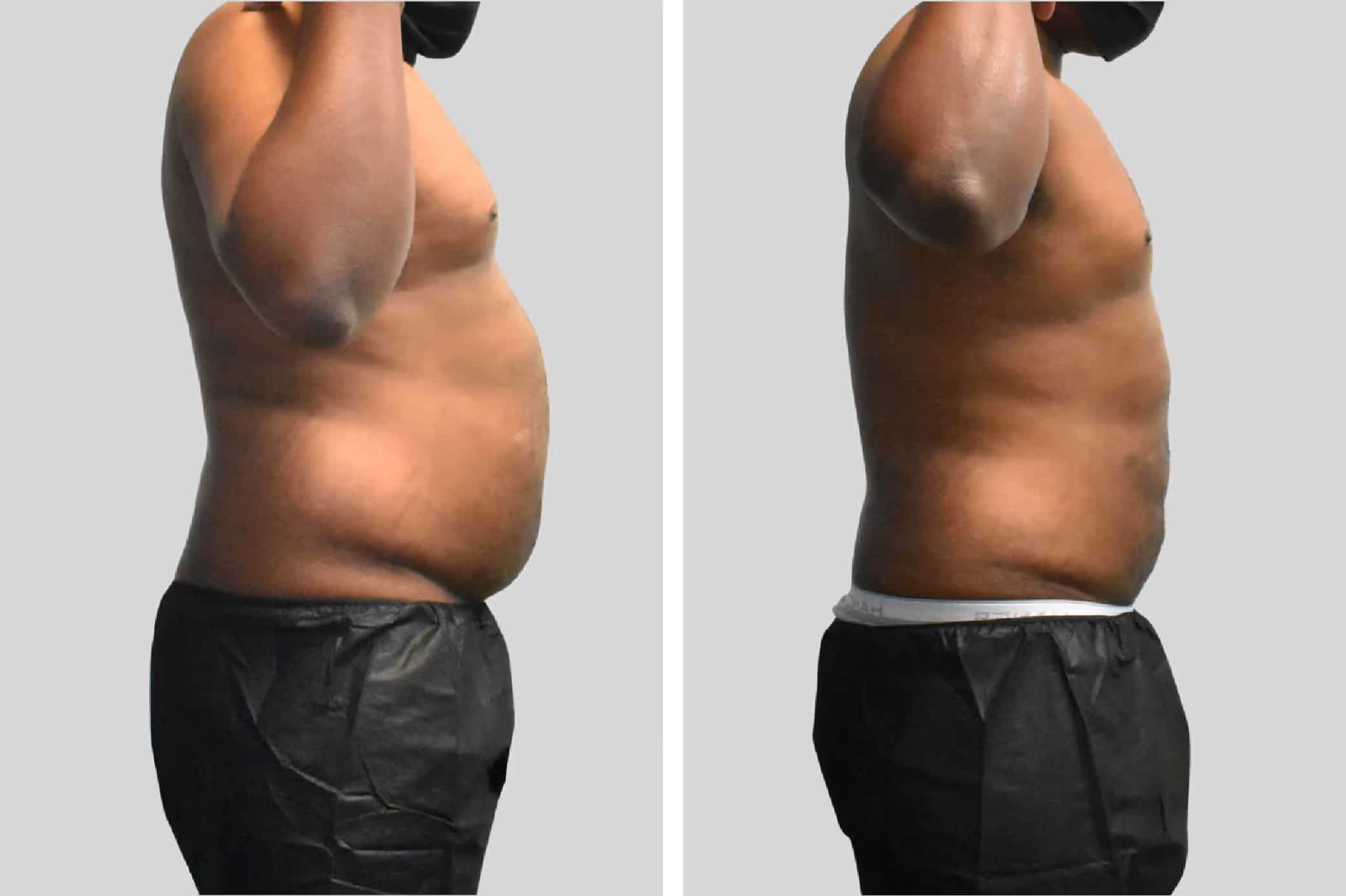Before and After Image: BelleSculpt 360 - right-side