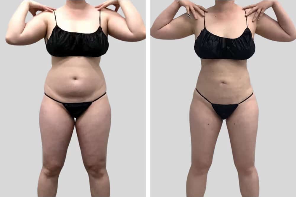 Before and After Image: BelleSculpt 360 - front