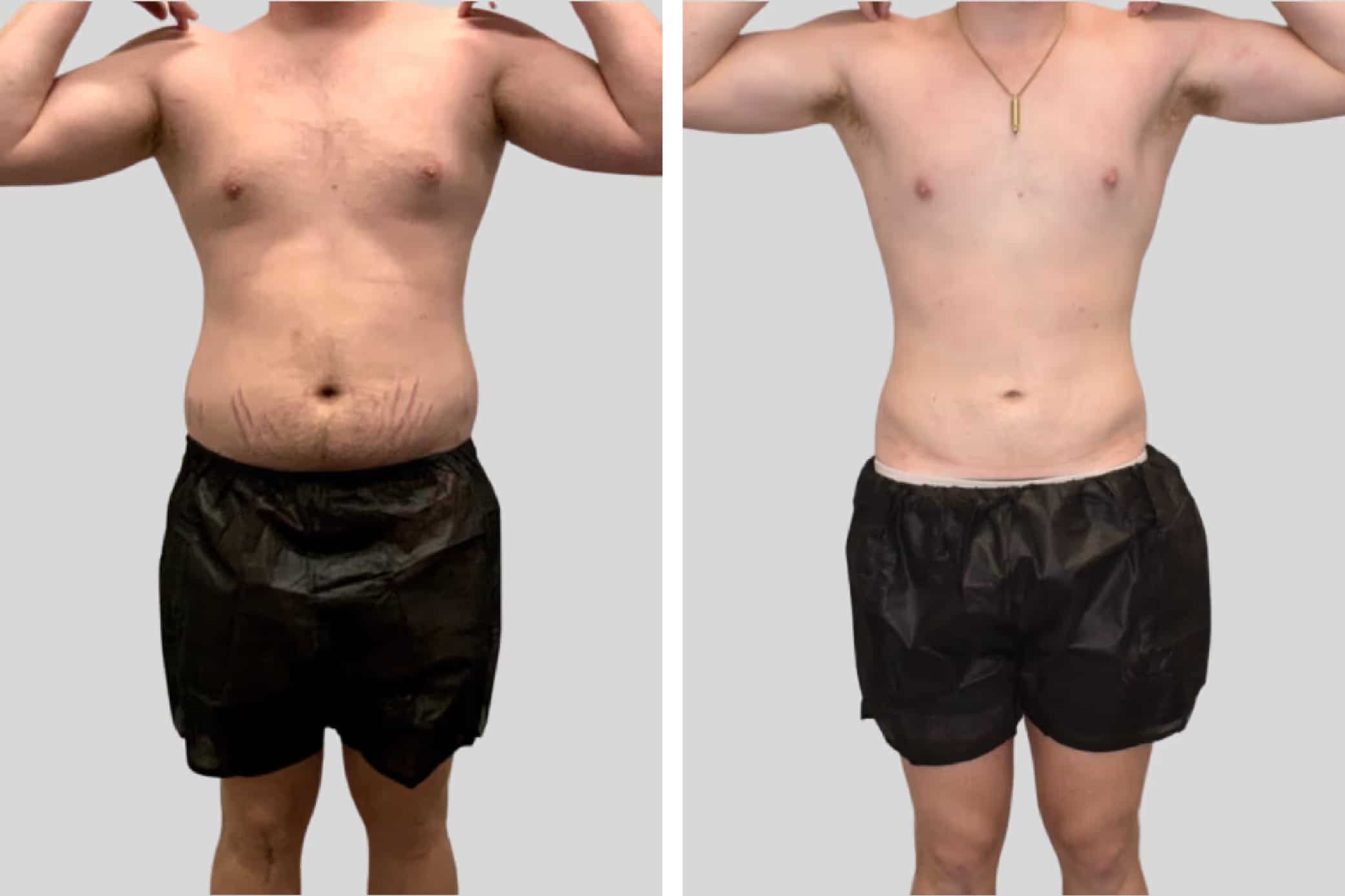 Before and After Image: BelleSculpt 360 - front