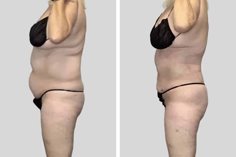 Before and After Image: BelleSculpt 360 - left-side