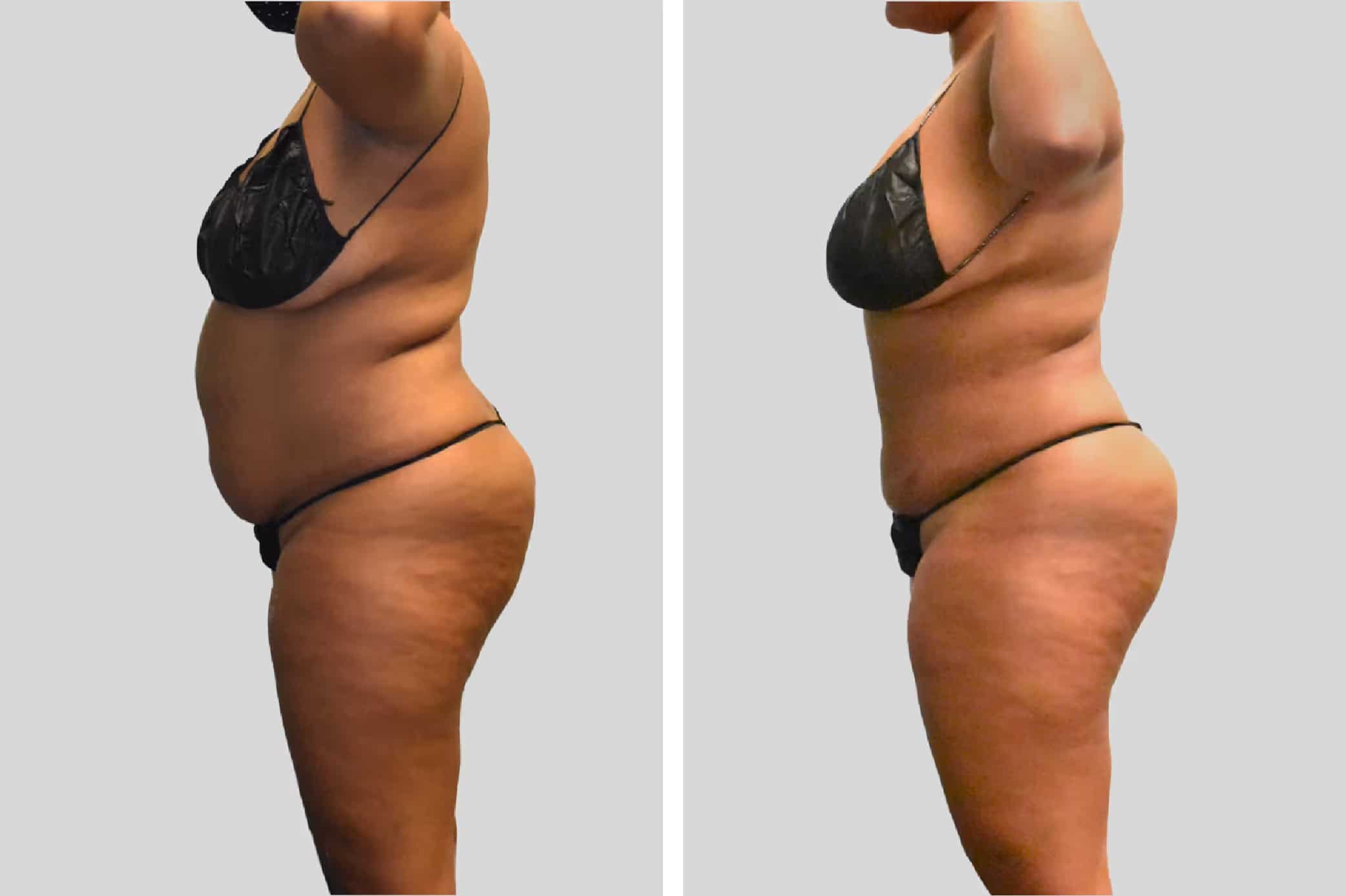 Before and After Image: BelleSculpt 360 - left-side