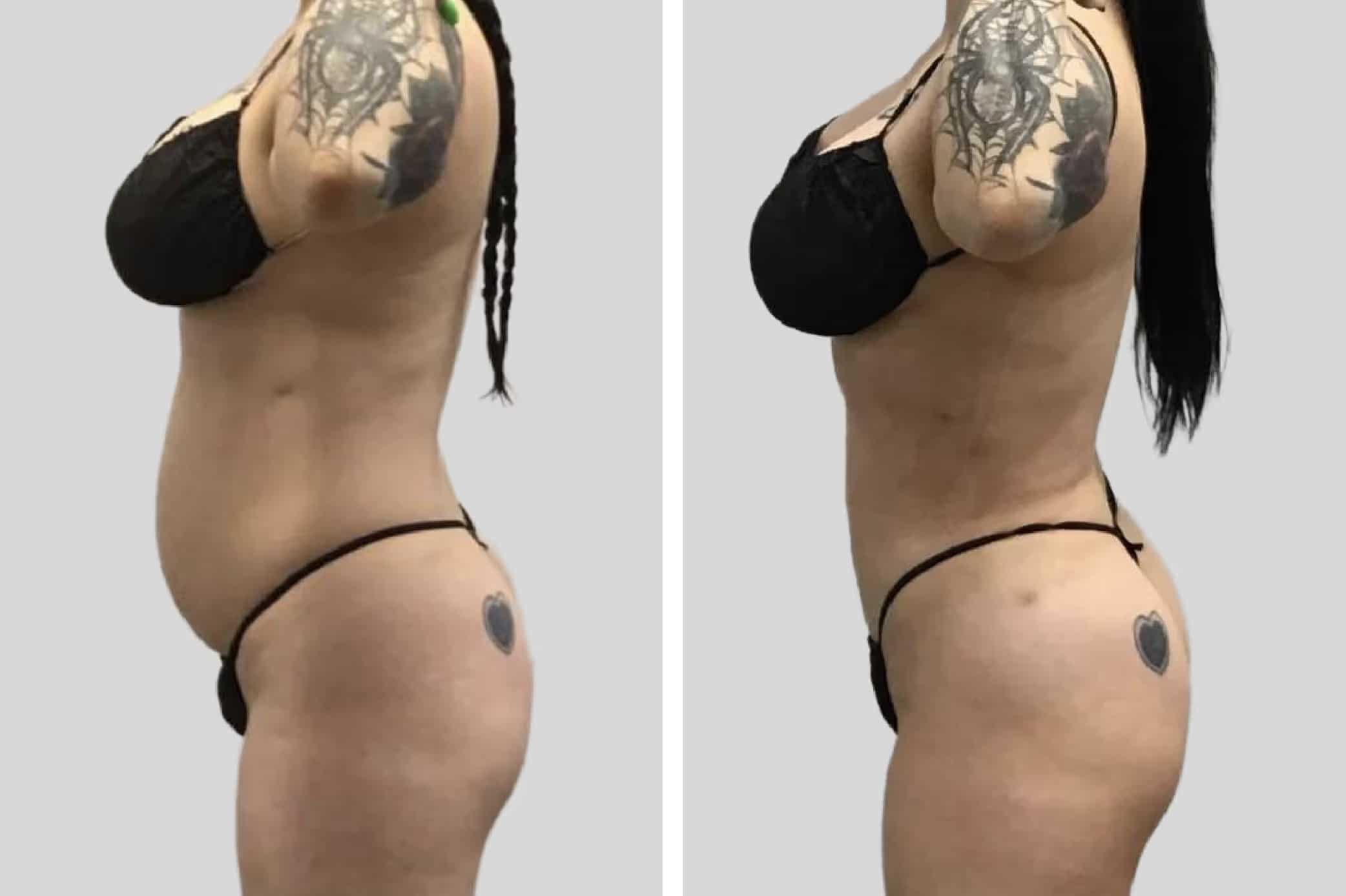 Before and After Image: BelleSculpt 360 - left-side