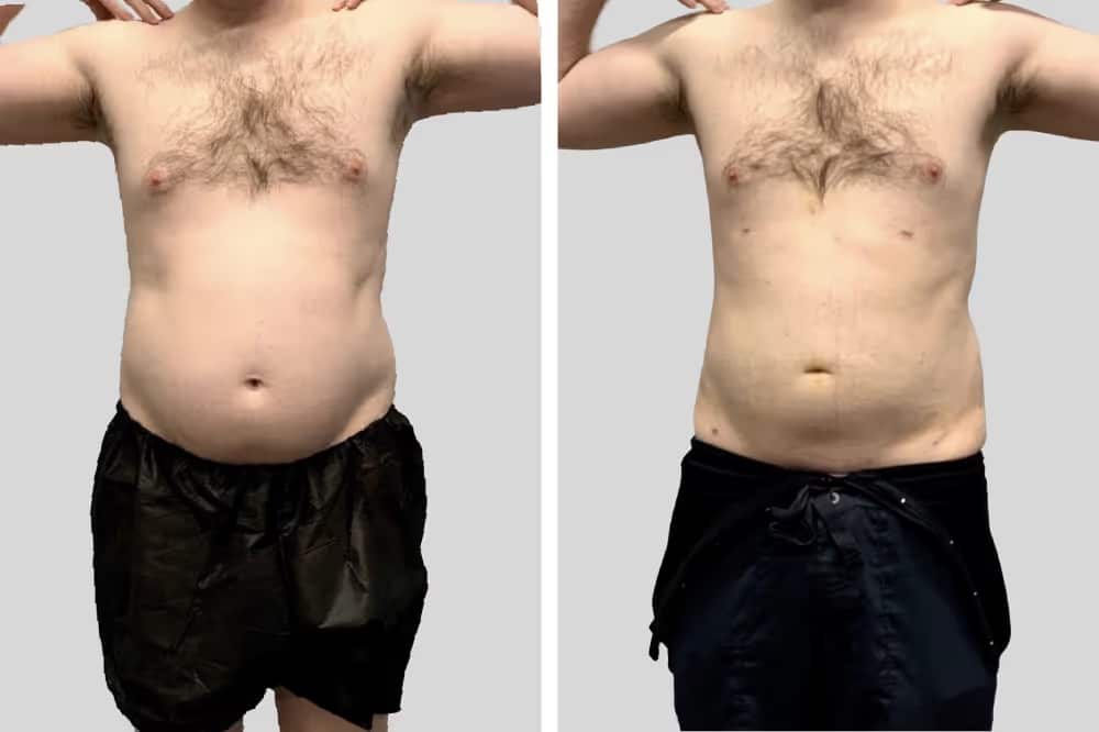 Before and After Image: BelleSculpt 360 - front