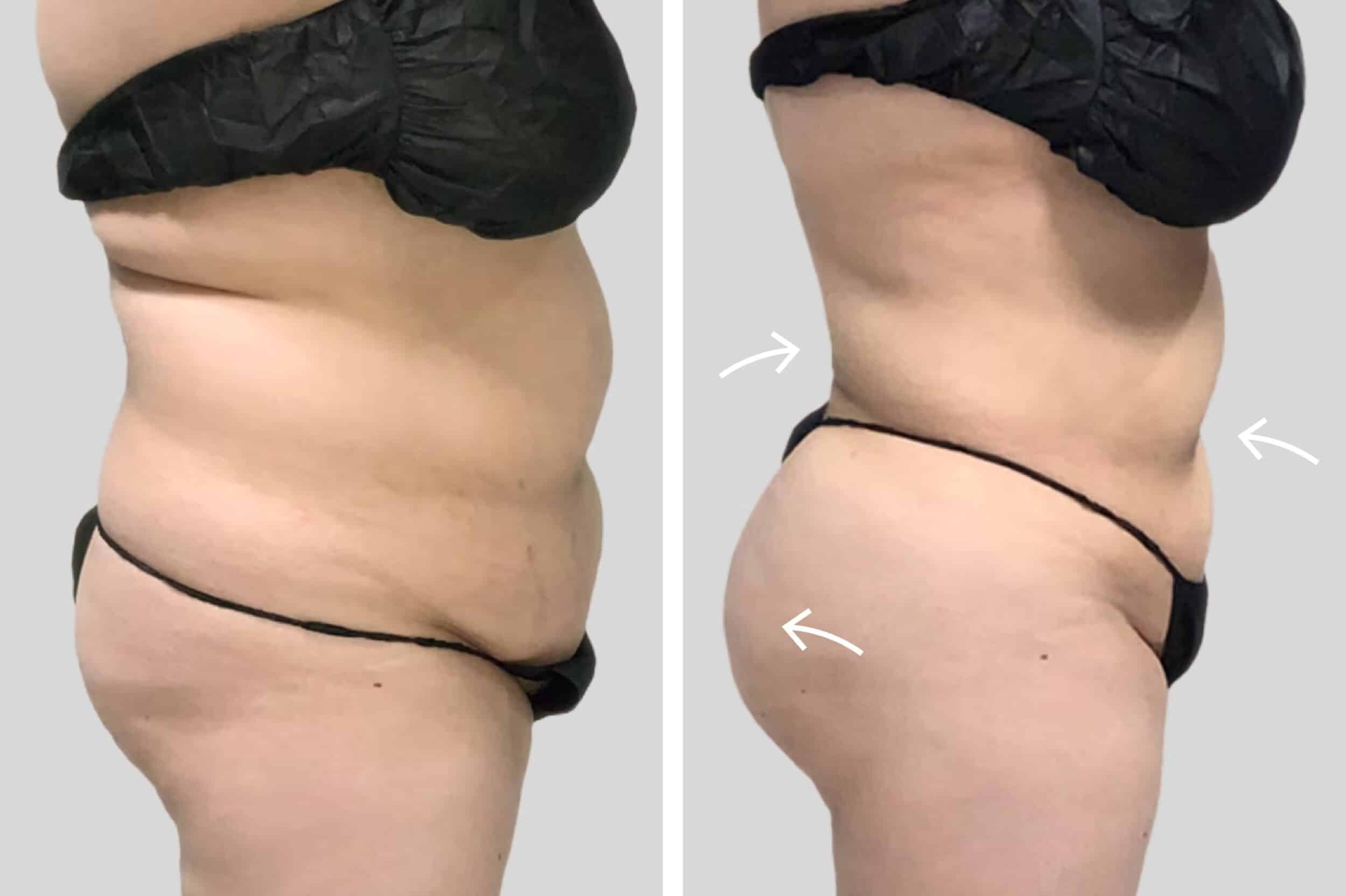 Before and After Image: BelleSculpt 360 - right-side