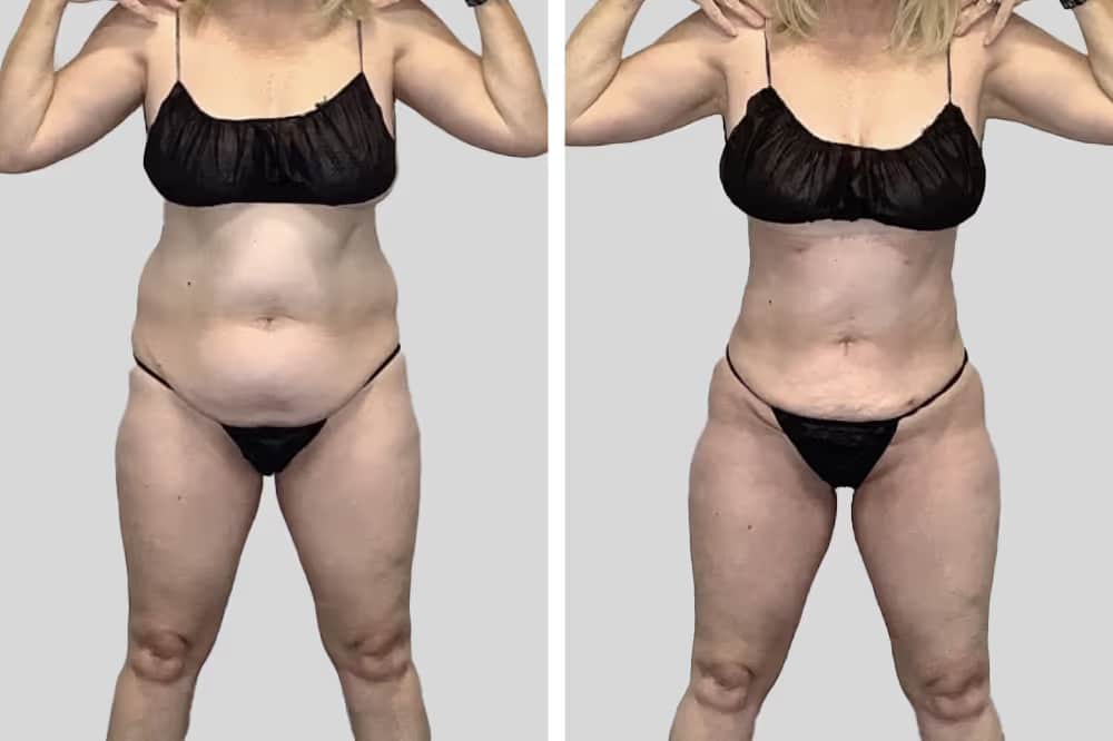 Before and After Image: BelleSculpt 360 - front