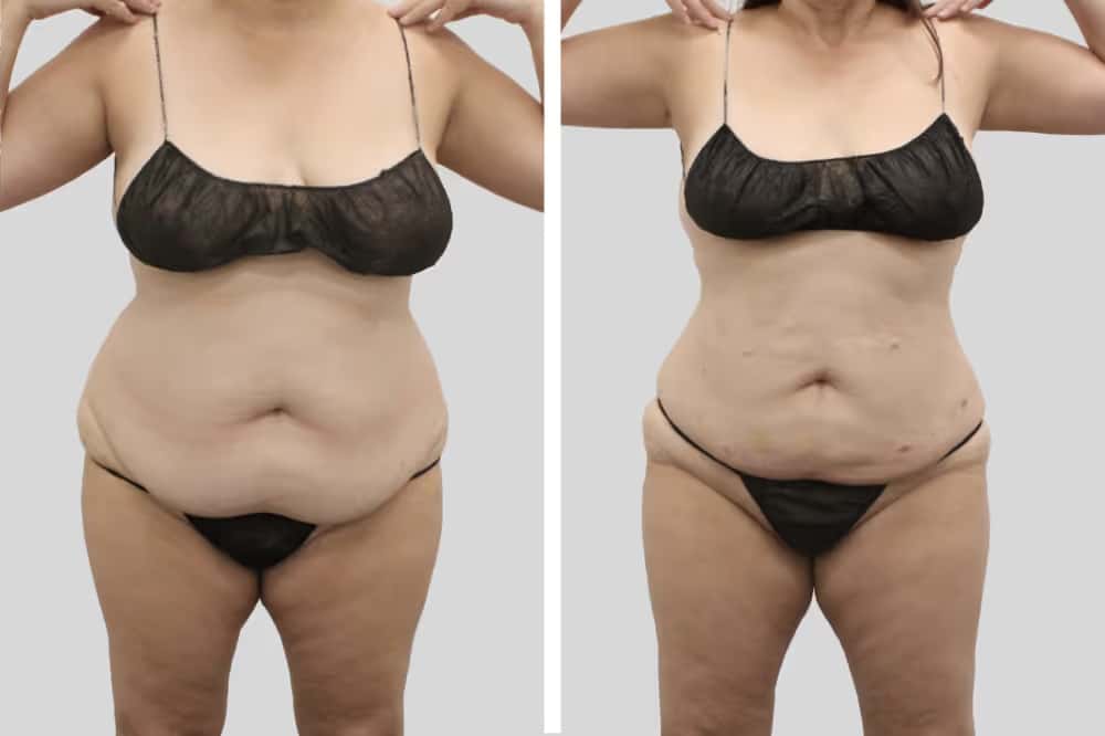 Before and After Image: BelleSculpt 360 - front
