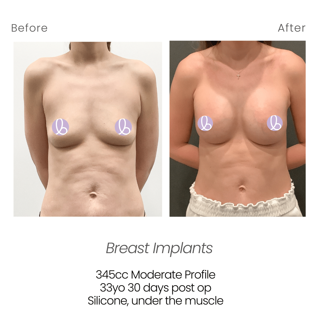 Before and After Image: Breast Implants - front