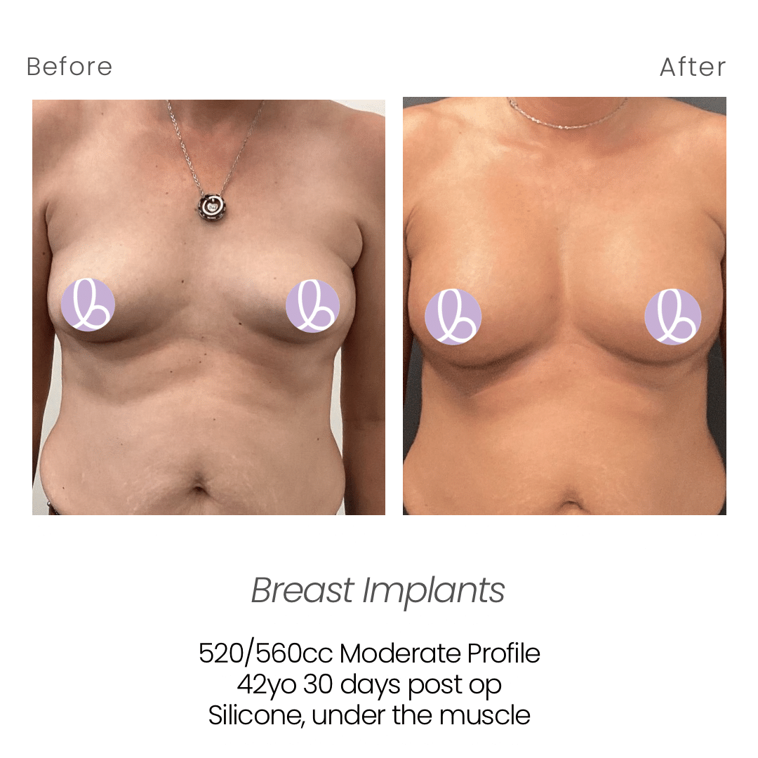 Before and After Image: Breast Implants - front