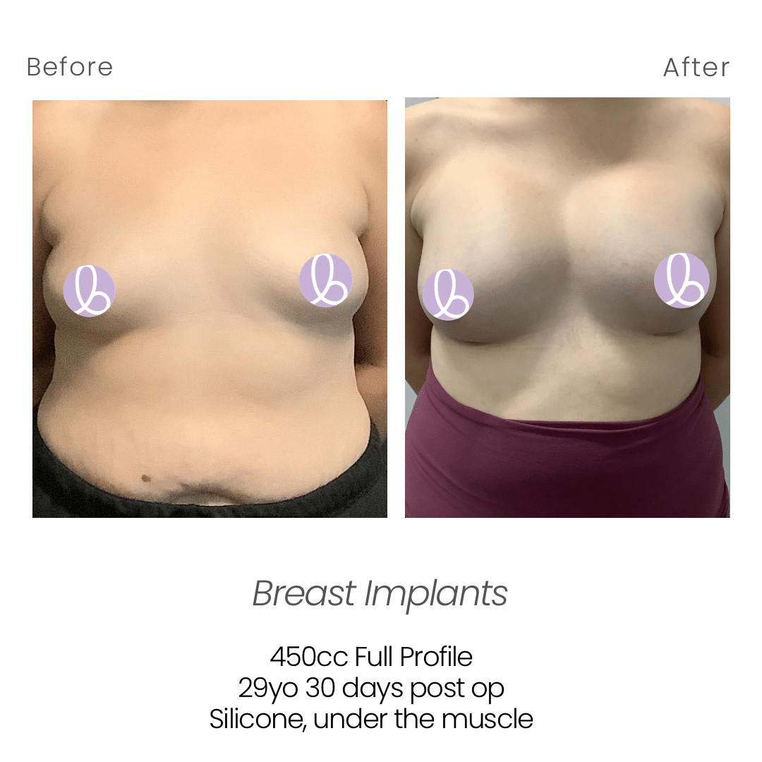 Before and After Image: Breast Implants - front