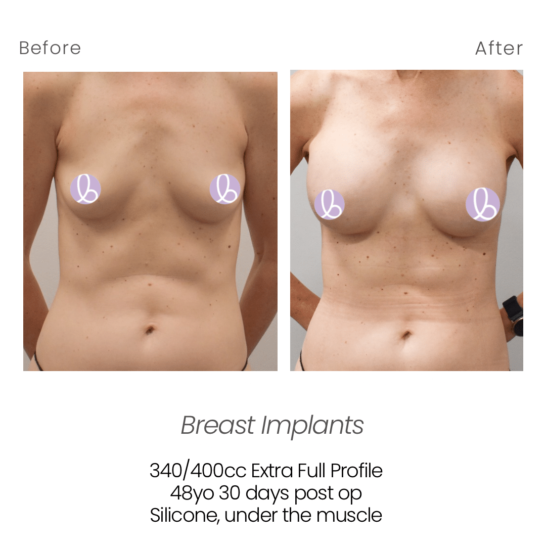 Before and After Image: Breast Implants - front