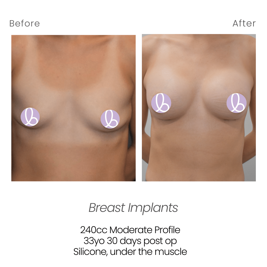 Before and After Image: Breast Implants - front