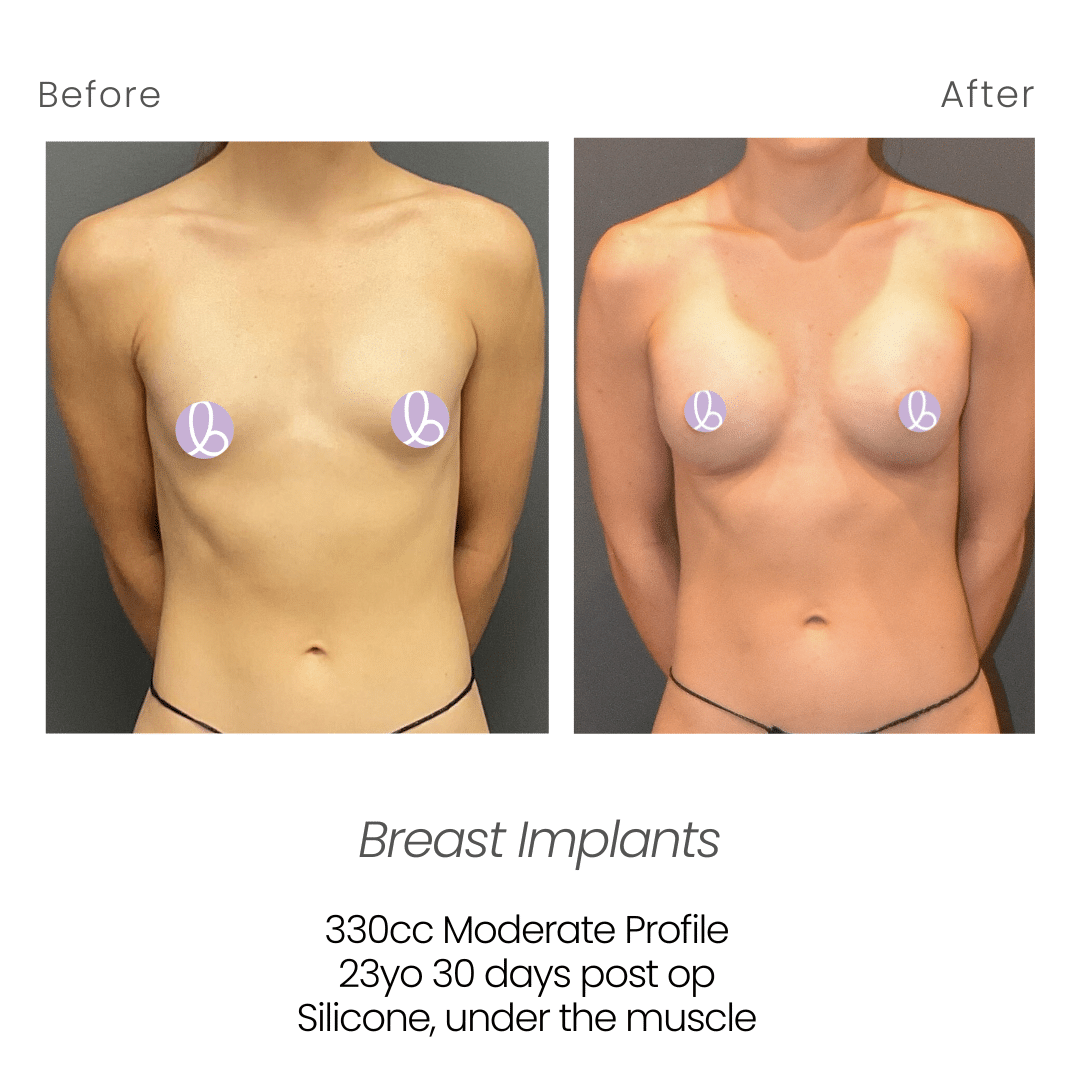 Before and After Image: Breast Implants - front