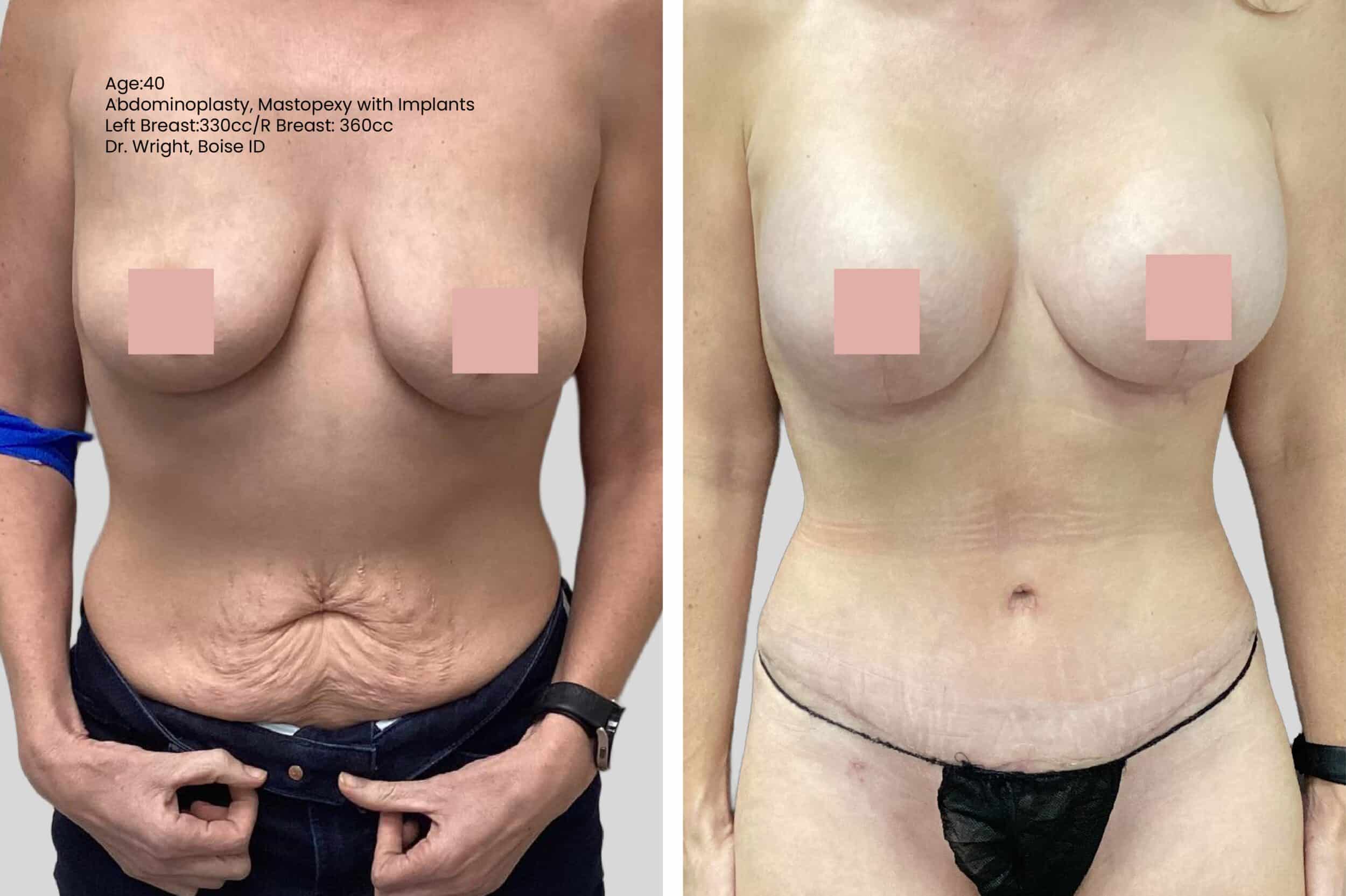 Before and After Image: Breast Lift - front