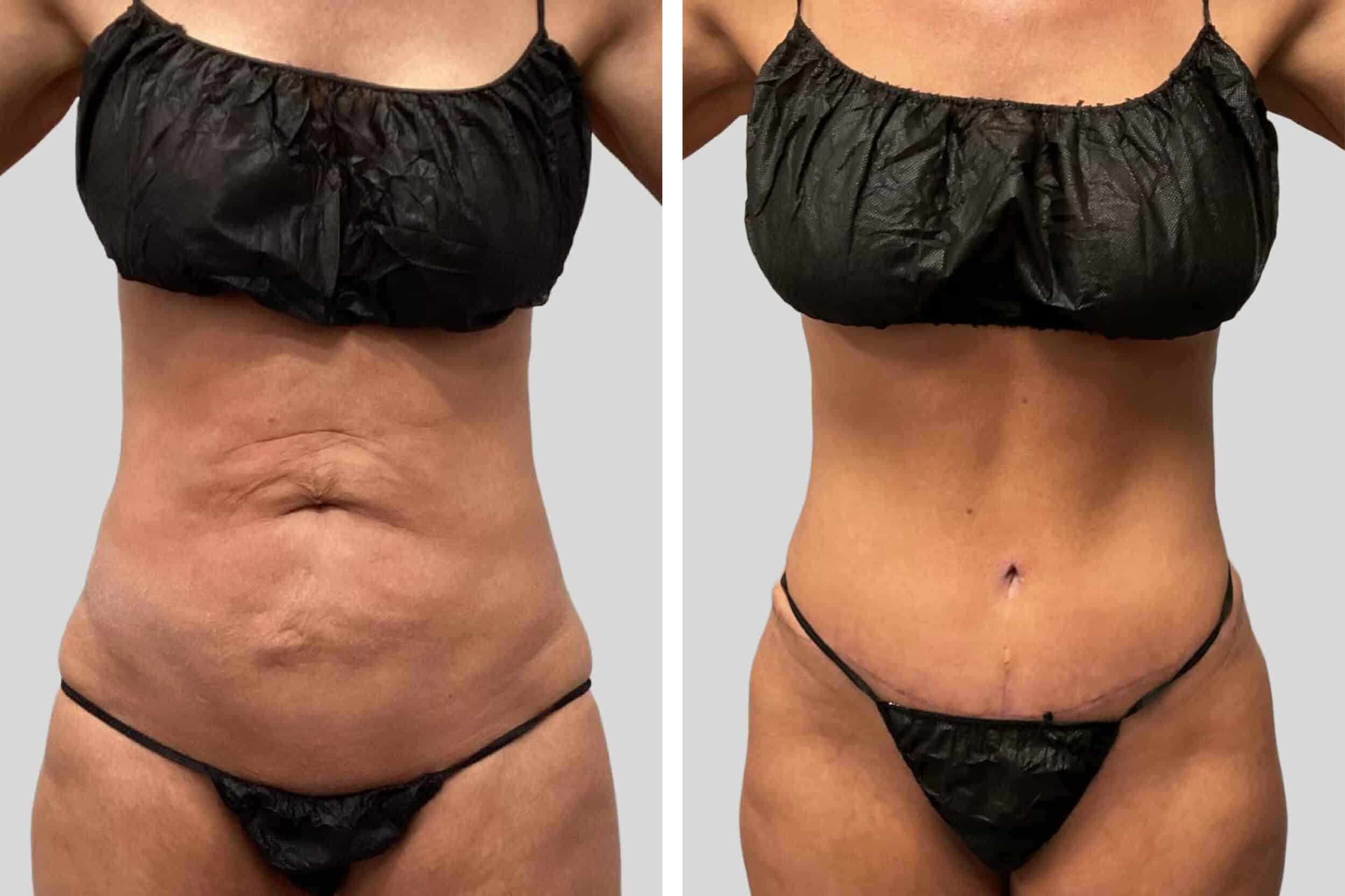 Before and After Image: Breast Lift - front