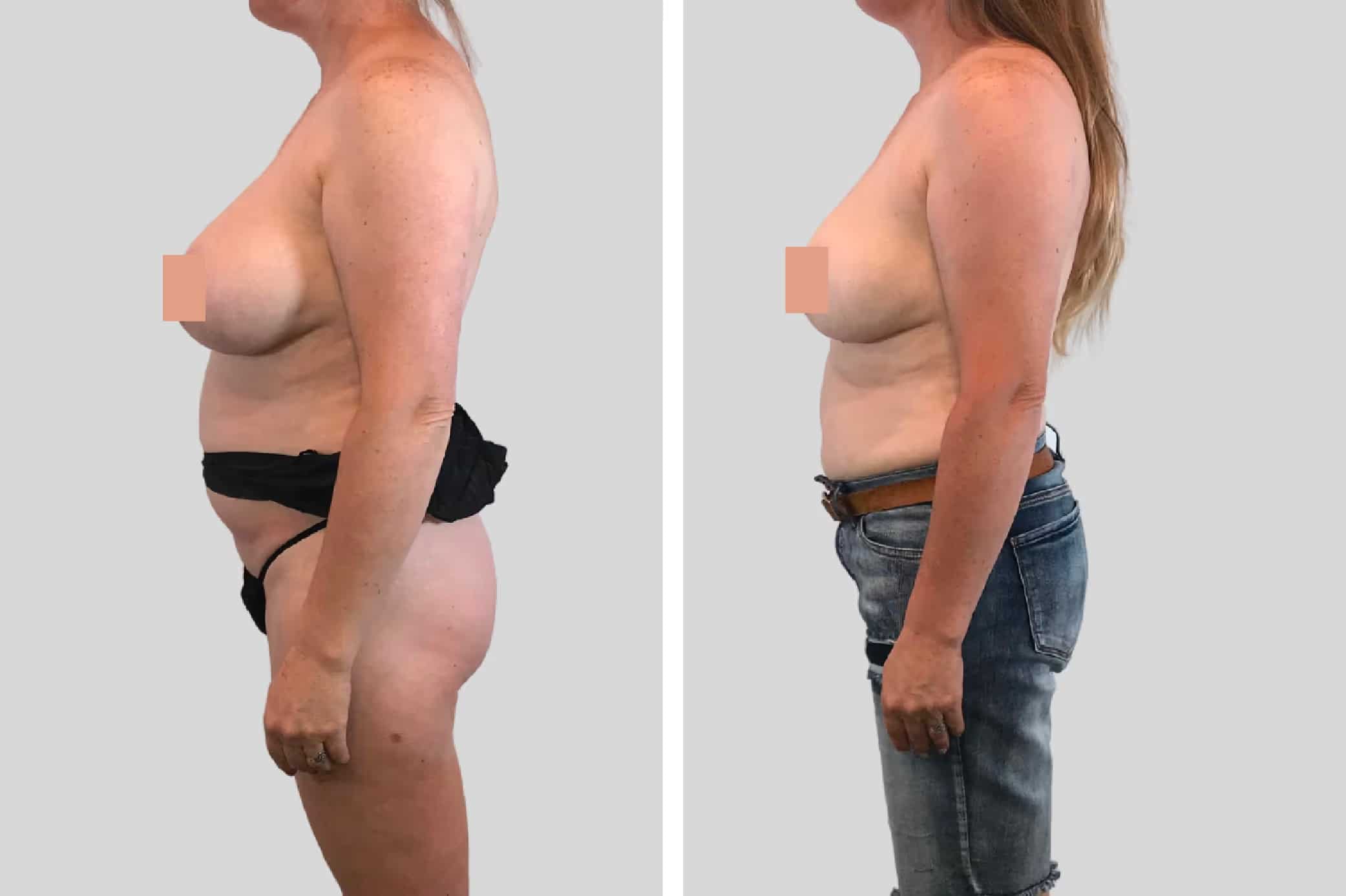 Before and After Image: Breast Reduction - left-side