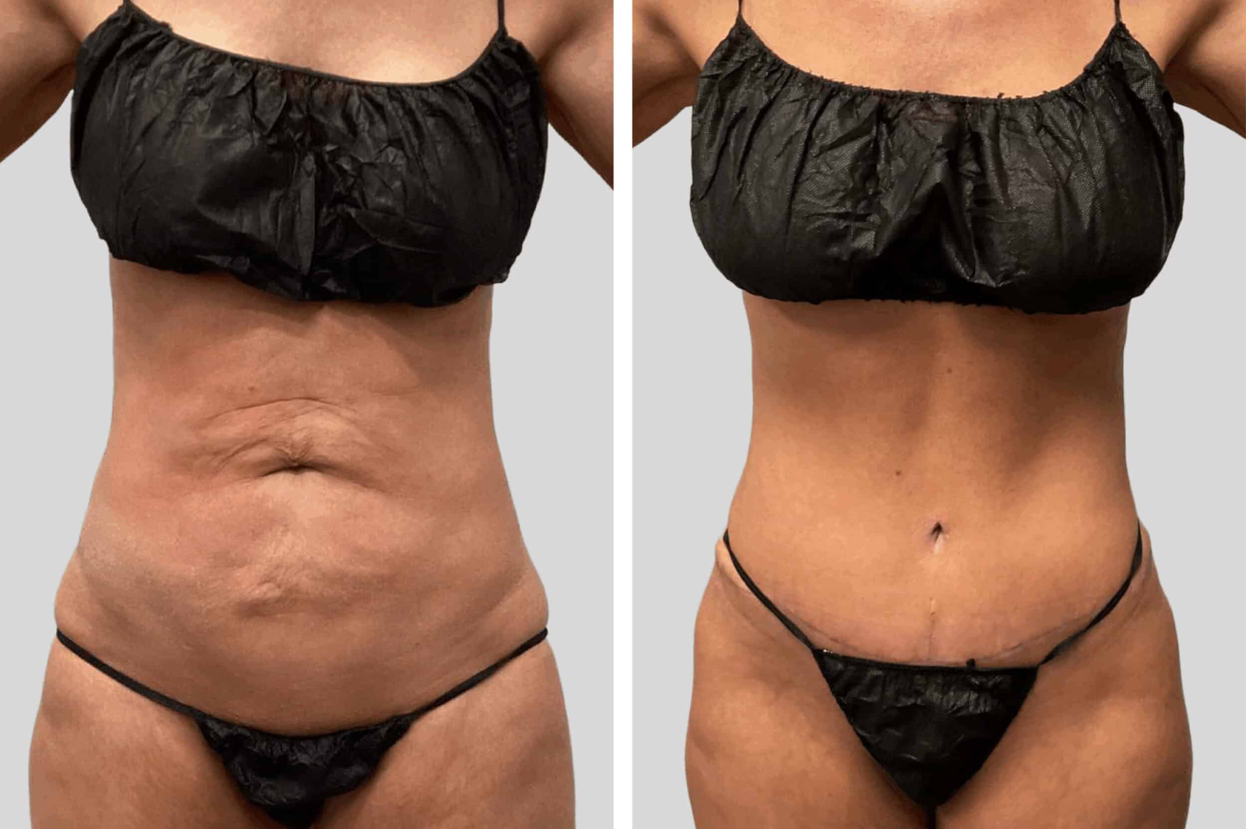 Before and After Image: Breast Reduction - front