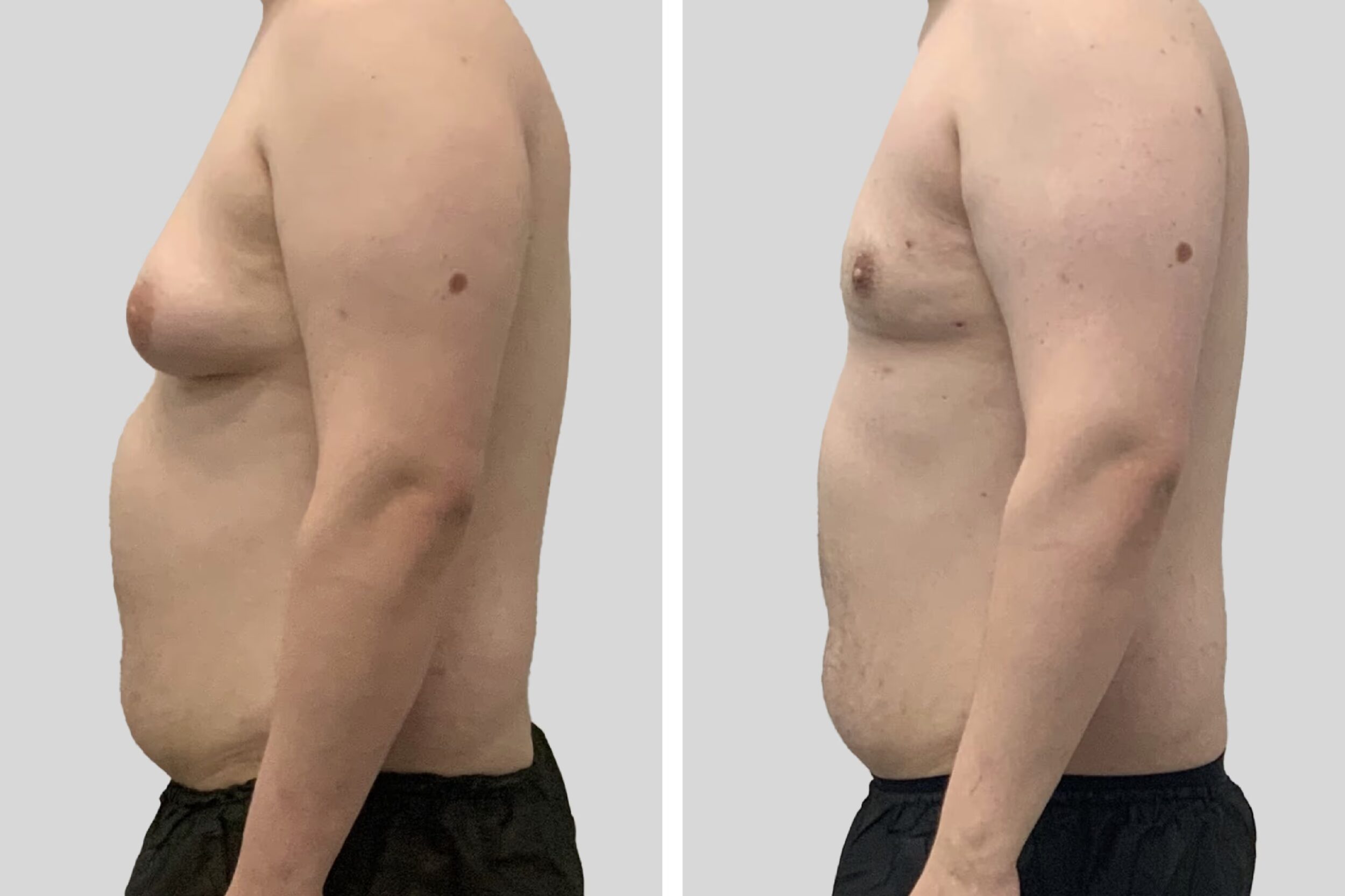 Before and After Image: Chest/Gynecomastia - left-side