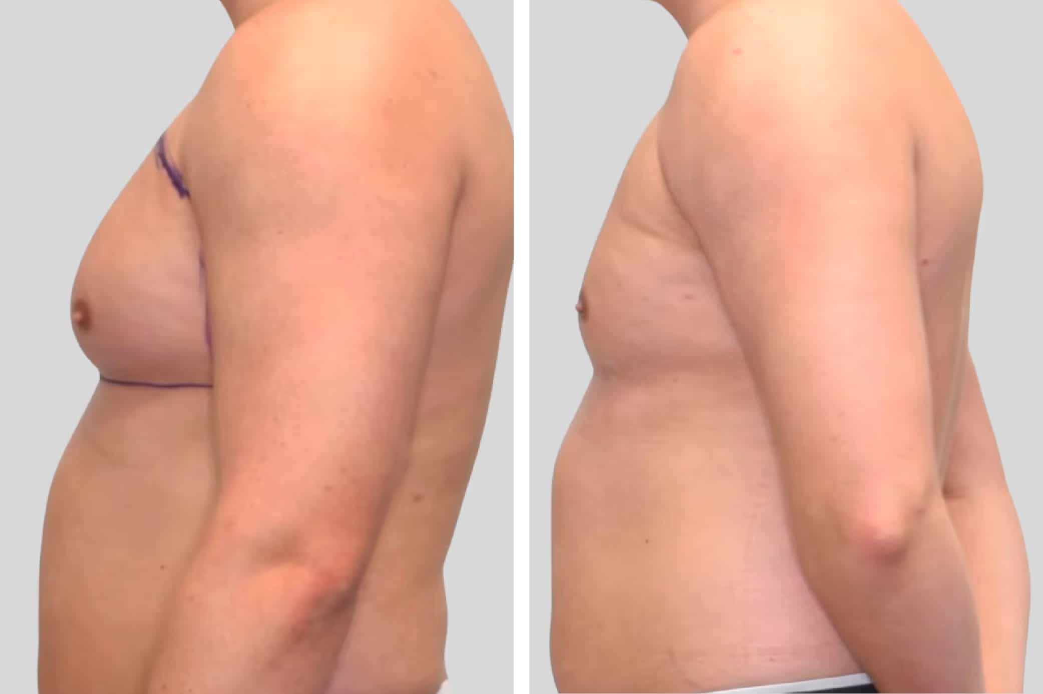 Before and After Image: Chest/Gynecomastia - left-side