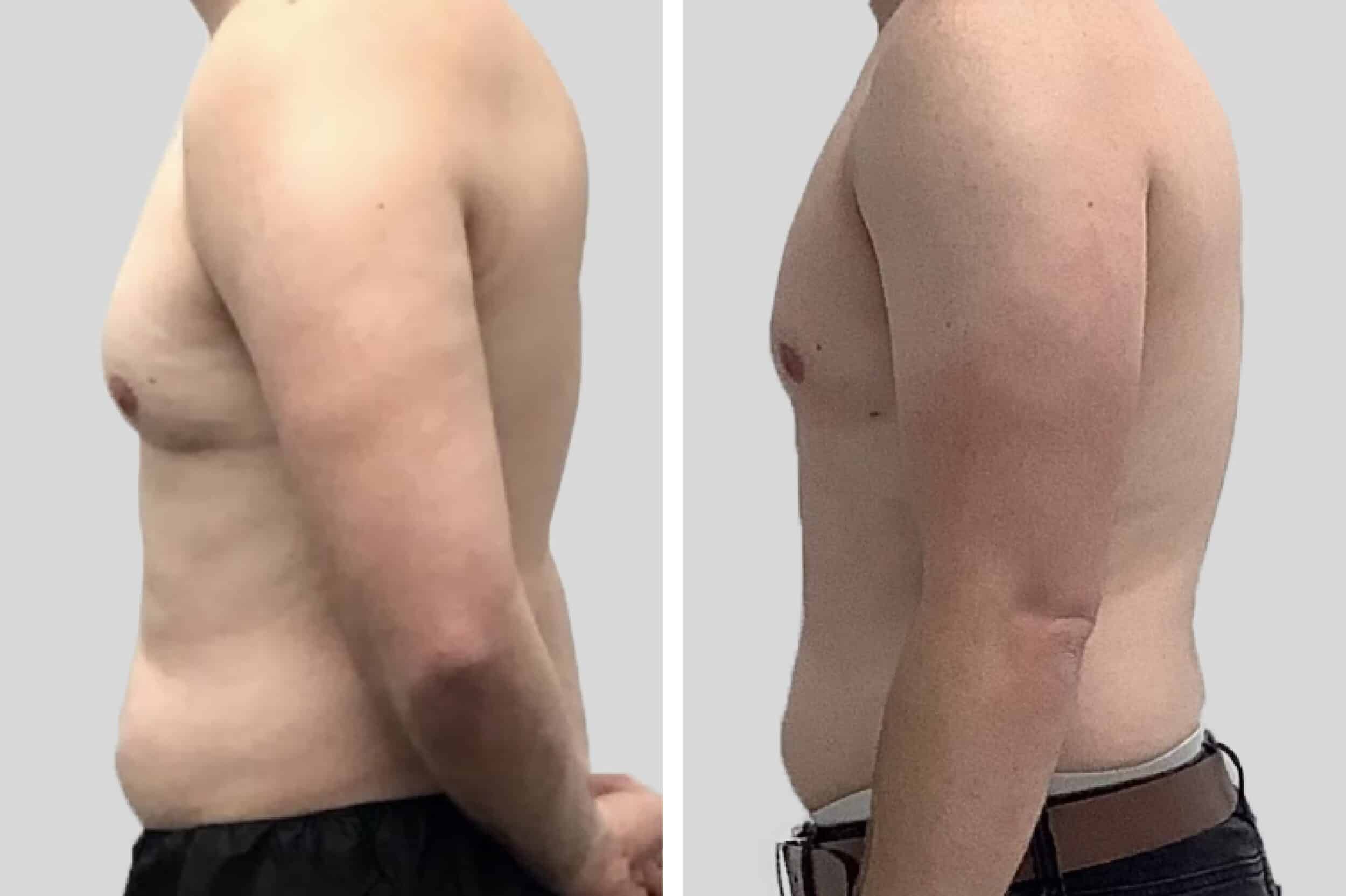 Before and After Image: Chest/Gynecomastia - left-side