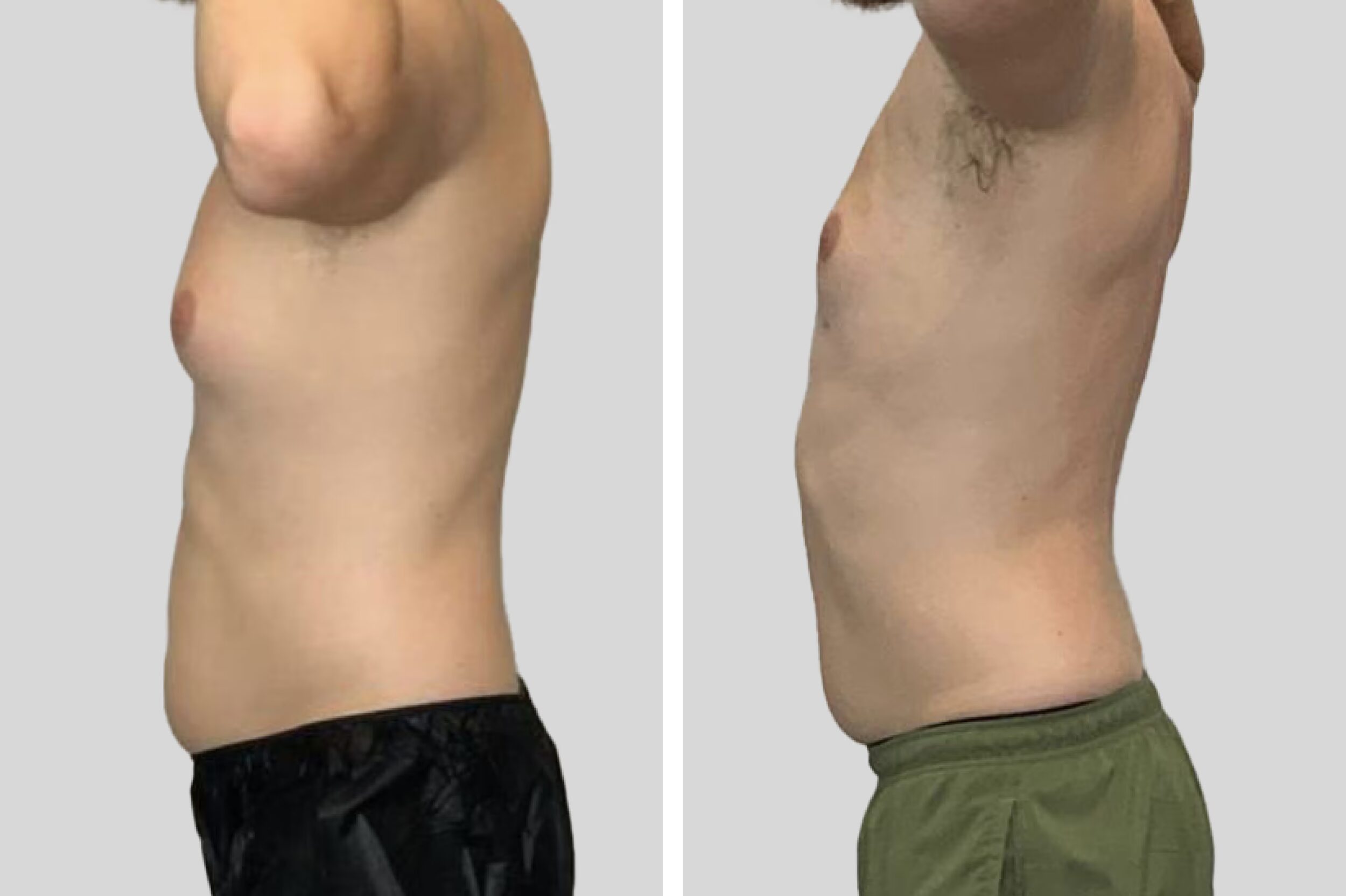 Before and After Image: Chest/Gynecomastia - left-side