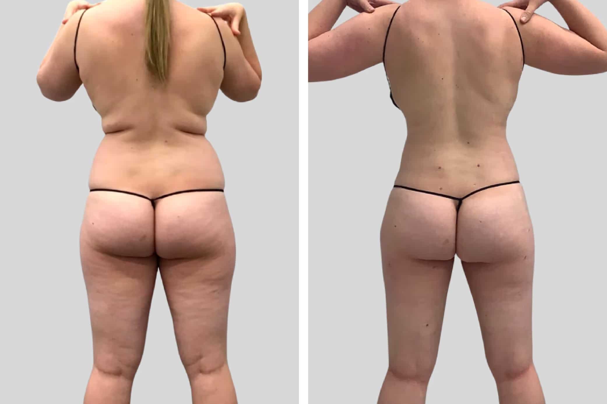Before and After Image: Flanks and Back - back