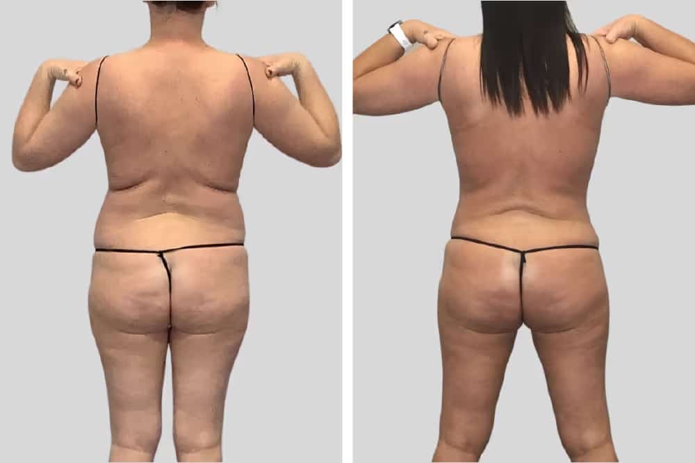 Before and After Image: Flanks and Back - back